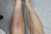 男子蹚水竟染上丹毒！雨天户外行走指南请查收