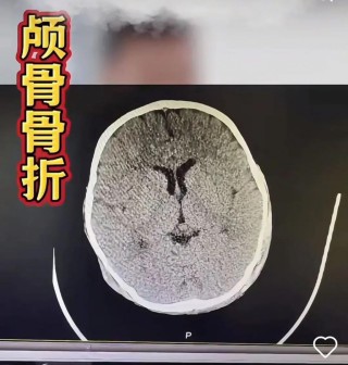 “人为撕裂”！3岁男童疑遭生父虐待，“脸肿得发亮”！警方已立案